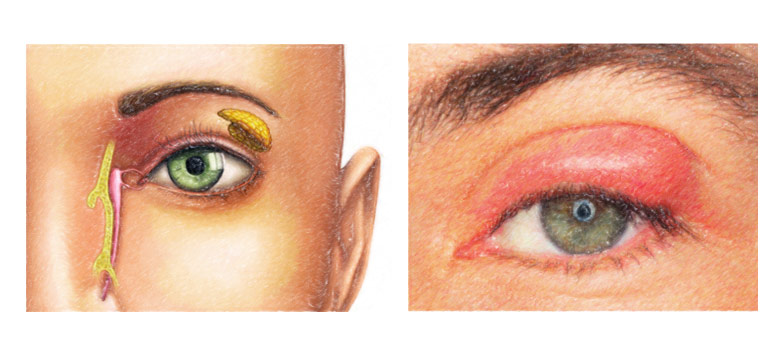 Symptome Bei Gerstenkorn