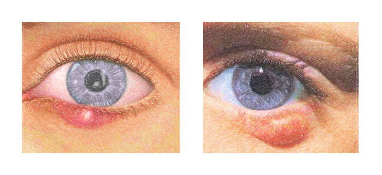 Hagelkorn (Chalazion)